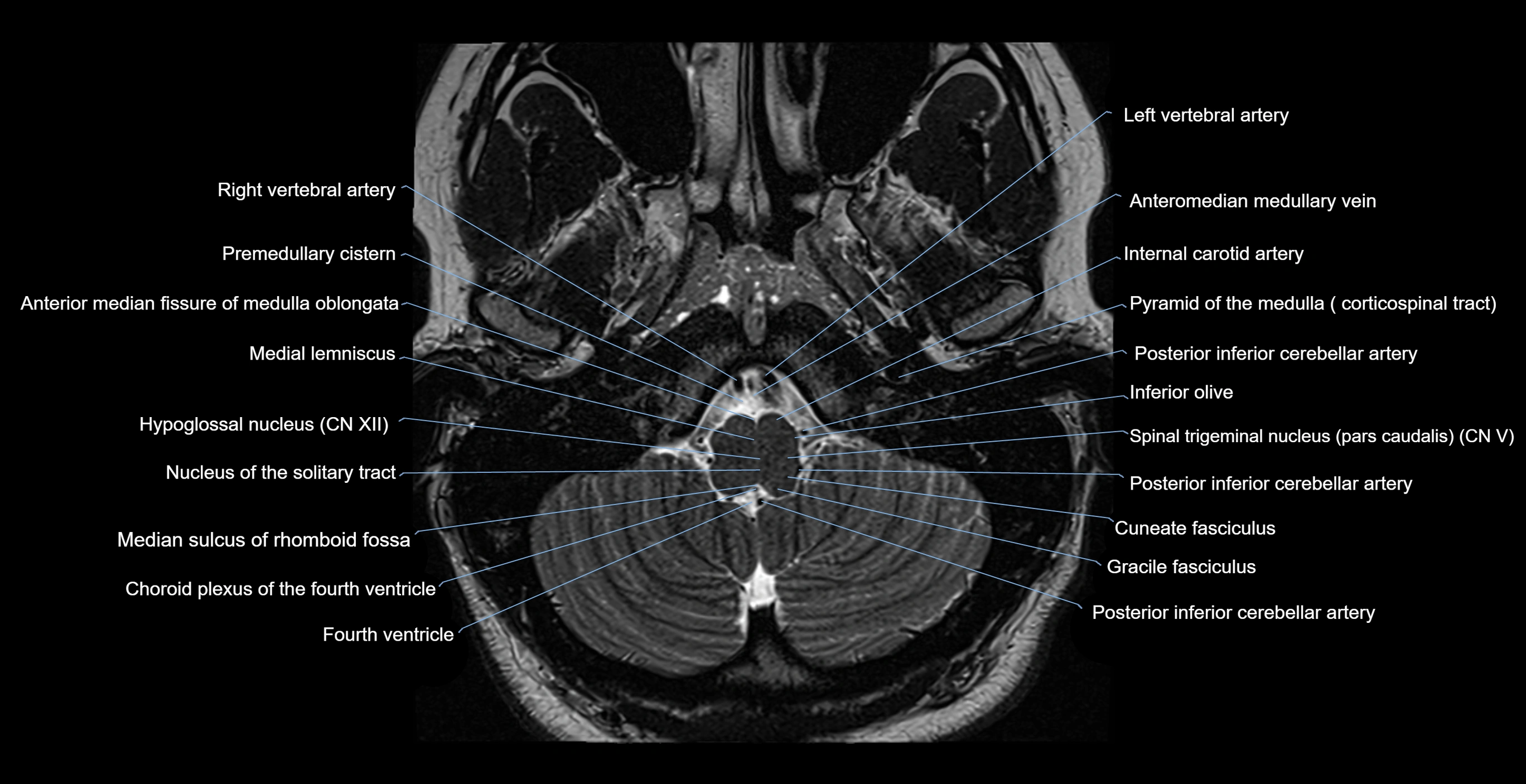 brain axial anatomy 3T MRI images -img-17001-00006.webp